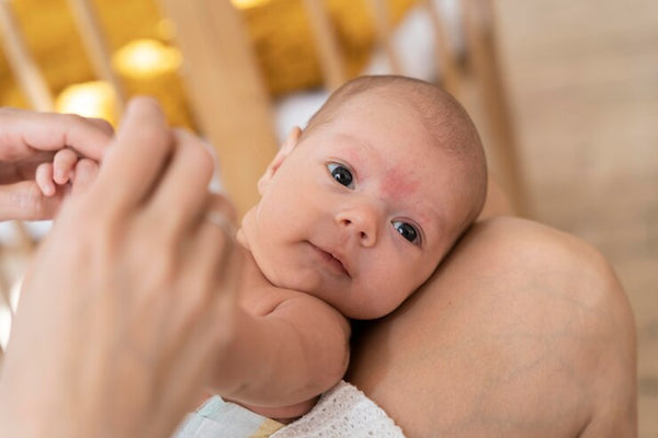 Apakah Jerawat pada Bayi Bahaya? Ini Sebab & Cara Atasinya